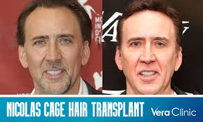 Nicolas Cage Hair Transplant: Unlocking the Enigma of His Potential Hair  Transplant