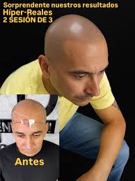 one of the most difficult treatments “KELOID SCAR”i One of the most  difficult to camouflage Keloid Scars..This treatment was a work in progress  and it's just about there.This client has been through