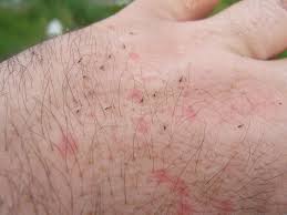 Individuals experiencing allergic reactions should stay away from infected areas. Can Fleas Bite Humans Fleacures Com