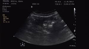 Aborto Por Que El Latido Fetal No Deberia Ser Un Indicador