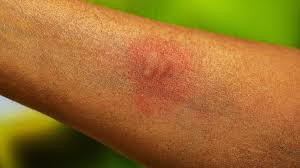 Image result for mosquito bite