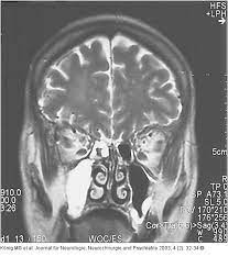 Abbildung 1 Sinusitis