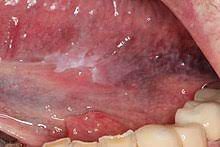 What do the early stages of mouth cancer look like? Oral Cancer Wikipedia