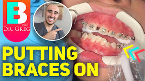 Rubber bands for braces are also known as elastics. Braces Explained Elastics Rubber Bands Youtube