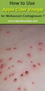 How To Use Apple Cider Vinegar For Molluscum Contagiosum Cider Vinegar Apple Cider Vinegar Cider