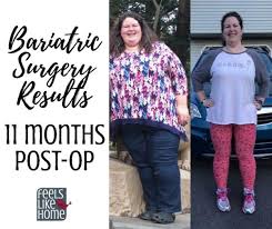 bariatric gastric sleeve surgery update