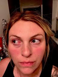 Lyme disease diagnosis and treatment for autoimmune disease patients