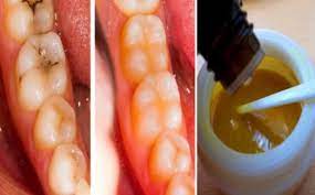 Reverse Cavities Naturally And Heal Tooth Decay In This Article We Will Present You With Tooth Masks That Can Help Y Reverse Cavities Tooth Decay Heal Cavities