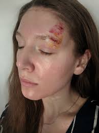 Motorcycle accident without helmet