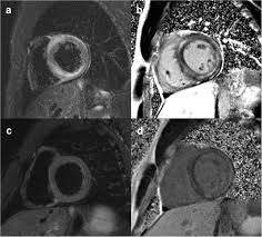 Classified as idiopathic, these cases are attributed to genetic factors, viral myocarditis, and autoimmune mechanisms. Cardiac Mri Evaluation Of Myocarditis Springerlink