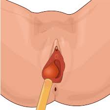 Image result for Bartholin's gland abscess