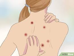 Most of the time your eyes can naturally flush out any foreign object with tears, but sand is slightly trickier and can damage your. 3 Ways To Get Rid Of Sandfleas Wikihow