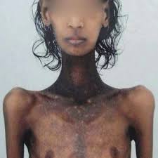 PDF) Addison's disease