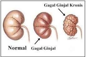 Penurunan fungsi yang paling parah adalah ginjal salah satu hal yang menjadi penyebab gagal ginjal kronik adalah adanya kanker prostat. Apa Bedanya Gagal Ginjal Akut Dan Kronis Prosehat