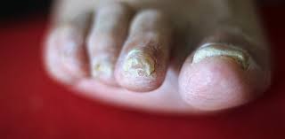A touch of white here, a rosy tinge there, or some rippling or bumps may be a sign of disease in the body. Explainer Why Do We Get Fungal Nail Infections And How Can We Treat Them