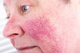 You're likely familiar with this uncomfortable feeling, but this is the right place. Rosacea Redness Small Vessels And Discomfort And Burning