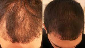 The rate of regrowth will be different for everyone. General Thinning International Hair Studio