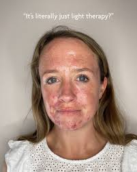 Dermalux LED Australia