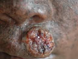 Yes, xeroderma pigmentosum causes complications if it is not treated. Xeroderma Pigmentosum Dermnet Nz