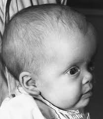 Image result for Hydrocephalus