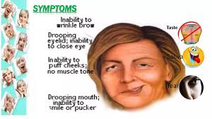 Facial nerve paralysis
