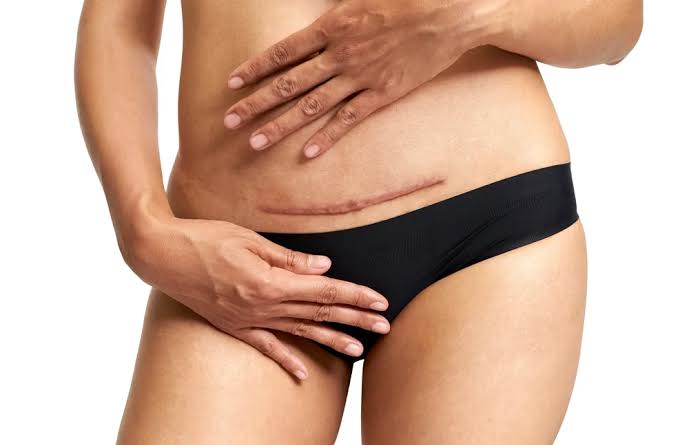 Scar Revision in Wilmette, IL | Women&amp;#39;s LifeCenter Aesthetic Surgery and  Medispa