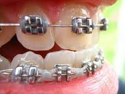 Frandsen Dental Quality Dental Care For All Ages And Smiles Braces Smile Getting Braces Dental Braces