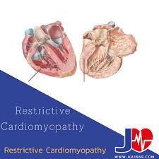 Image result for Restrictive Cardiomyopathy