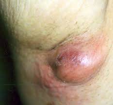 Home diseases and conditions pea sized lump in armpit. Lump Under Armpit Painful Pea Sized Causes Treatment And Pictures Lightskincure