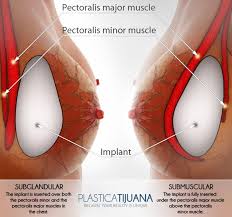 Breast Augmentation