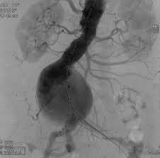 Endovascular Today Abdominal Aortic Aneurysms In Women