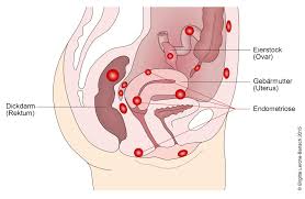 Elle est liée à la présence de tissu semblable à la muqueuse utérine en dehors de l'utérus. Endometriose Deximed