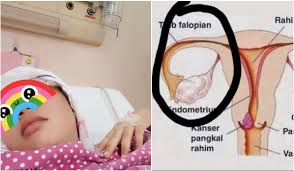 Check spelling or type a new query. Akibat Makan Ikan Haruan Wanita Baru Bersalin 15 Hari Terpaksa Buang Apendiks Ovari