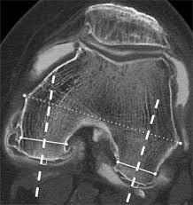 Lateral aspect of medial femoral condyle most common location. Cartilage Thickness At The Posterior Medial Femoral Condyle Is Increased In Femorotibial Knee Osteoarthritis A Cross Sectional Ct Arthrography Study Part 2 Osteoarthritis And Cartilage