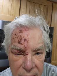 Good morning all (from the UK)….so just my thoughts 🤔….Im now around 11  weeks in ( 4/5 Post Rash…Torso and Back RHS). The post pain was at first  awful…but I took a