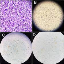Kanker jenis ini bermula dari sel limfosit (salah satu jenis sel darah putih) yang berkembang secara abnormal. A 48 Year Old Woman With Primary Non Hodgkin Lymphoma Of The Right Download Scientific Diagram