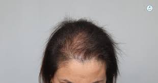 La calvizie negli uomini può comparire fin dai 16 anni · vero · tagliare spesso i capelli contribuisce a rafforzarli e quindi a fermare la caduta . Alopecia Da Trazione Tricomedica Blog E News