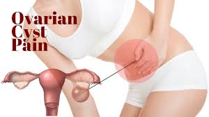 But other times, your ruptured ovarian cyst can make itself known in an extremely unpleasant way. Ovarian Cyst Pain Cyst On Ovary Ruptured Ovarian Cyst Youtube