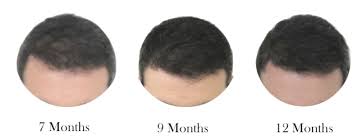 The level of hair loss though will be dependent on some very key factors. Hair Growth Period Hair Deluxe Clinic En