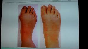 Wann sollte der hallux valgus operiert werden? Hallux Valgus Operation Am Zehenschiefstand Youtube