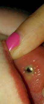 Die schwellung ist neben rötung, schmerz, wärme und eingeschränkter funktion ein kardinalsymptom einer entzündung. Wachst Mein Madonna Piercing Ein Lippe Schwellung Eingewachsen