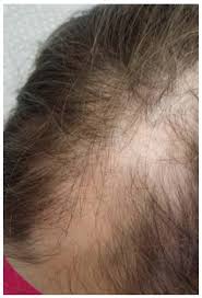 That said, the connection between zinc and hair loss has been studied, and results are rather mixed. Can Hair Loss Assessments Predict The Severity Of Zinc Deficiency In The Pediatric Population A Prospective Observational Study Semantic Scholar