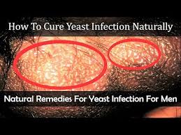 Try these home remedies to treat oral thrush effectively in a natural way. How To Cure Yeast Infection Naturally Home Remedies For Yeast Infection For Men Youtube