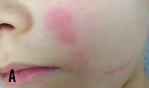 Image result for Urticaria pigmentosa children