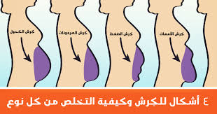 4 أشكال لتوزيعة الدهون في البطن الكرش وكيفية التخلص من كل نوع منها