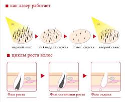 Плюсы и минусы удаления волос лазером: советы специалистов