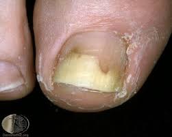 Image result for Onycholysis feet
