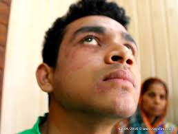 Tinea Ringworm Infection On Face Homeo Energy If you have athlete's foot and ringworm on your hands, it's important to treat both your feet and hands. drug transmission through hair