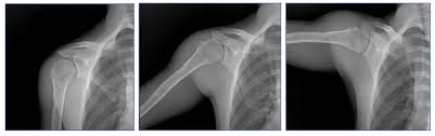 Image result for Shoulder XRay