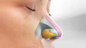 These treatments usually involve less bleeding than conventional surgery. Nose Reshaping Rhinoplasty Johns Hopkins Medicine